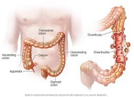 What Causes Diverticulitis Symptoms Of A Diverticulitis Flare Up Diverticulitis is a condition marked by inflammation or infection of pouches, referred to in medical terms as diverticula, that form in the digestive system. what causes diverticulitis symptoms