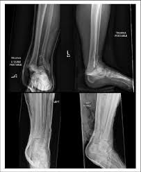 Image result for Ankle Dislocation