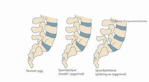Dubousset j., katti e., seringe r. Hva Er Spinal Stenose