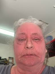 Support and Prayers for Chronic Skin Disease and Missing Mother