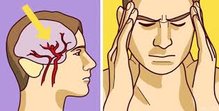 Aneurisma cerebral también conocido como aneurisma intracraneal o intracerebral es un punto débil o fino en un vaso sanguíneo cerebral que sobresale como un balón y se llena de sangre.el aneurisma saliente puede poner presión sobre un nervio o tejido cerebral circundante. Sai Cos E Un Aneurisma Cerebrale Come Prevedere Il Pericolo Prima Che Sia Troppo Tardi