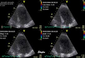 Pin On Echocardiography