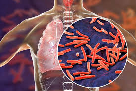 This term refers to not only girls but the male gender also. Tuberculosis Alone And With Hiv Co Infection Treatment Updates Pulmonology Advisor
