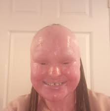 Woman whose skin grew too fast for her body dies at 32