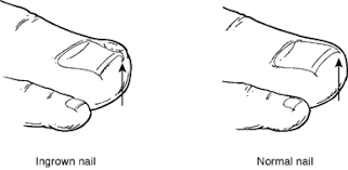 Skin next to the nail becoming tender, swollen, or hard. Ingrown Toenail Acfas