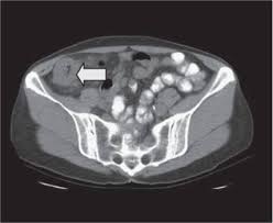 However, cats suffering from colon cancer will defecate more often than usually. Abdominal Ct Scan Colon Cancer Ct Scan Machine