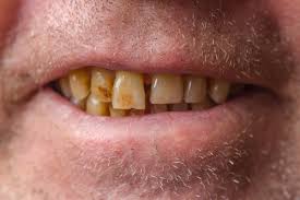 Tooth color usually plays an important role in how others will perceive you. Foods That Stain Your Teeth Buffalo Dental Group Free Consultation
