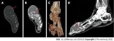 Image result for Chondrosarcoma