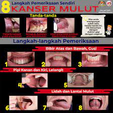 Tanda amaran awal kanser mulut termasuk luka mulut, tompok putih atau merah, dan kelembutan atau kesakitan. Minggu Kesedaran Bahagian Kesihatan Pergigian Selangor Facebook