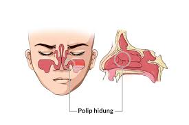 Punca dan sebab hidung tersumbat. Polip Hidung Gejala Penyebab Dan Mengobati Alodokter