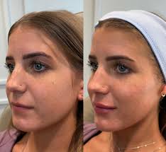 Lip augmentation using 0.8mL Restylane Kysse 💋 #lipfillers  #lipfillerbeforeandafter #aesthetics #desmoinescosmetics #iowa