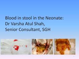 Image result for Blood in stool