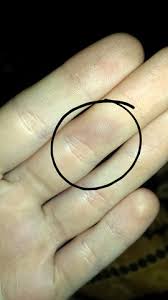 Ader Am Finger Wird Blauer Und Dicker Medizin
