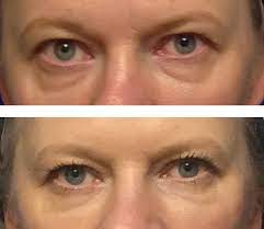 Juvederm Was Placed Below The Eyes To Minimize Under Eye Bags Chicago Dermal Fillers Expert Injector Cheryl Perlis Dermal Fillers Under Eye Bags Med Spa