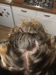 That's because many signs and symptoms of thyroid disease develop on the skin, hair, and nails. Hair Loss Worse On Ndt Week 7 On Ndt And Hair Thyroid Uk