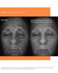 Some before and afters from our newest innovation Muti-acid Enzyme Peel!!  Go ahead and check these out!!