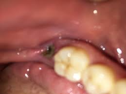 What does the wisdom tooth healing process even look like? Blood Clot Wisdom Tooth Reddit Novocom Top