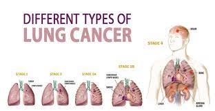 What are the signs and symptoms of lung cancer? Types Of Lung Cancer Symptoms Causes And Difference