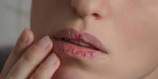 Maybe you would like to learn more about one of these? 8 Penyebab Bibir Kering Dan Pecah Pecah Wajib Diketahui Merdeka Com