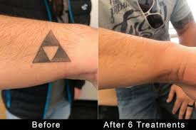 The advanced technology of laser removal does a clean work in the most comfortable way ever. Best Tattoo Removal Los Angeles Tattoos Remove