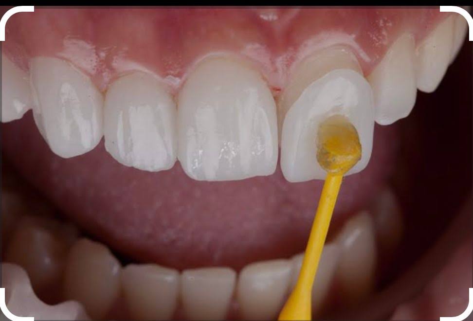 VENEERS product image