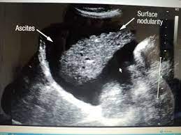 Your provider at urgent care 24/7. Liver Pathology Ultrasound Images Ultrasound Sonography Diagnostic Medical Sonography Ultrasound