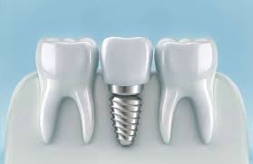 Dental Implants Newcastle | Dental Implants Cost from £1800