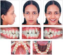 Sometimes before extraction, the orthodontist only places the braces and no wires so the dentist knows exactly which teeth have to be. Scielo Brasil Tooth Extractions In Orthodontics First Or Second Premolars Tooth Extractions In Orthodontics First Or Second Premolars