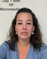 This is today, 1 day after RF Microneedling!! I have some redness and  swelling around my eyes and my cheeks look pink and sunburned. But if you  didn't know I had a
