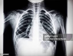 Image result for Chest XRay