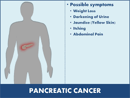 Upon diagnosis, patients often look back and start to make a connection between various symptoms that seemed unrelated or unremarkable at the time. Symptoms Of Cancer Of The Pancreas Net Health Book