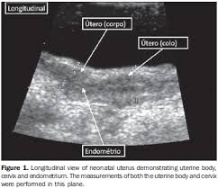 Another ultrasound image (right) shows the bilateral pelvic kidneys adjacent to the ovaries and posterior to the urinary bladder. Scielo Brasil Ultrassonografia Pelvica Em Criancas E Adolescentes Ultrassonografia Pelvica Em Criancas E Adolescentes