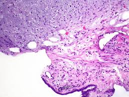 Jump to navigation jump to search. Hamartoma Pathophysiology Wikidoc