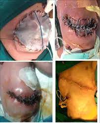 What is the abbreviation for bogota bag? Bogota Bag Technique Of Closure Of Abdominal Contents Download Scientific Diagram