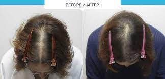 There are currently numerous clinics offering stem cell hair regrowth procedures in the. Discover The Revolutionary One Off Treatment For Thinning Hair And Alopecia By Olivier Amar Cosmetic Finesse In The Heart Of London