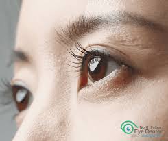 Image result for Eye Discharge