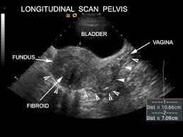 Www Stritch Luc Edu Lumen Meded Radio Curriculum Obgyn Fibroids1 Htm Diagnostic Medical Sonography Ultrasound Sonography Ultrasound Technician
