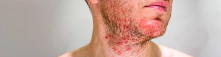 Image result for Seborrheic Dermatitis