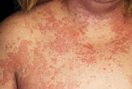 Boils are skin infections that can appear as lumps. Pictures Of Bumps On Skin Cysts Skin Tags Lumps And More