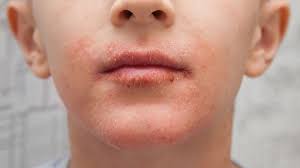 Jika anda memiliki freckles dan ingin menghilangkannya, anda dapat mempertimbangkan metode berikut Ini Penyebab Sekaligus Obat Bibir Bintik Bintik Dan Gatal Yang Bisa Anda Pilih