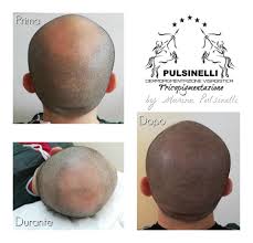 Fondamentalmente la micropigmentazione è definita come un tipo di tatuaggio che include la tecnica del microblading. Infoltimento Dei Capelli Con Tricopigmentazione Seduta Di 2 Ore