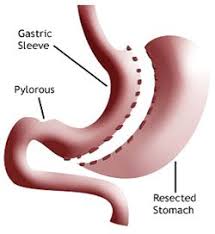 Gastric Sleeve Treatment Abroad Refunded By Nhs