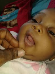 See full list on mayoclinic.org Much Ado About Tongue Tie Ask The Paediatricians Foundation