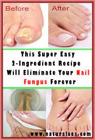 Get Rid Of Nail Fungus Forever With 2 Natural Ingredient Vita Mirabilis Nail Fungus Toe Fungus Remedies Fungus Treatment