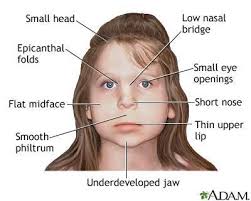 Fetal alcohol syndrome epicanthal folds flat nasal bridge small palpebral fissures upturned nose. Fetal Alcohol Syndrome Facial Anatomy