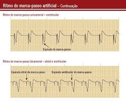 2 globulina se eleva precocemente na fase aguda e pode ser utilizada também para o seguimento da atividade da doença. Aprendendo Ecg Posts Facebook