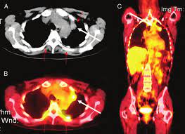 The images are displayed on a monitor for your a breast pet scan is used only after a woman has been diagnosed with breast cancer. Fdg Pet Scan Identification Of A Primary Lung Carcinoma In A Patient Download Scientific Diagram