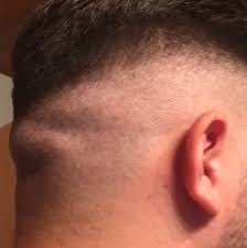 Dicke Beule Im Hinterkopf Gefahrlich Bilder Gesundheit Leben Korper