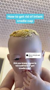 Image result for Cradle Cap