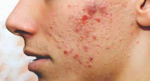 How To Treat A Hard Pimple